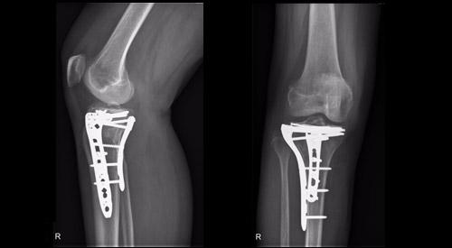 Röntgenbeelden na een plaat-schroefosteosynthese van een 2-pijler tibiaplateaufractuur