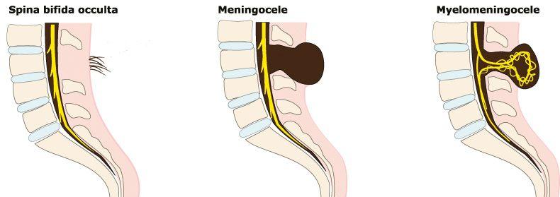 3 vormen van spina bifida
