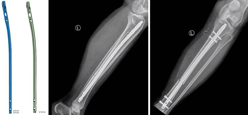 Voorbeeld van een titanium mergpen die in het bot geplaatst wordt