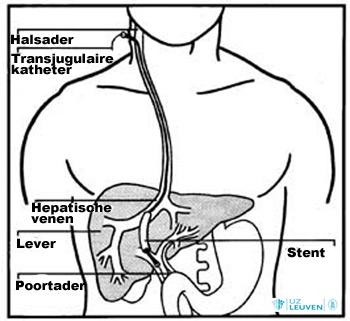 Plaatsen van een intrahepatische stent