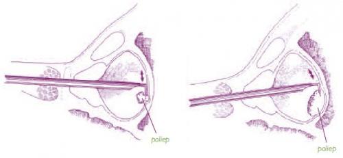 Illustratie hoe poliep uit blaas verwijderd wordt via plasbuis
