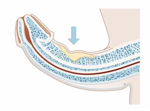 Harde knobbels in het verbindweefsel zorgen voor een verkromming en verkorting van de penis.