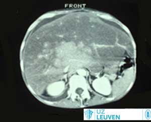 CT-scan van opgezwollen lever van patiënt met Budd-Chiari.