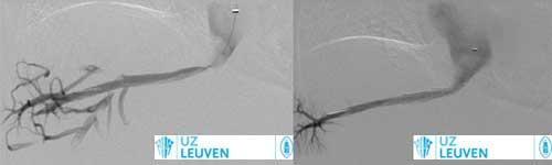 Geïsoleerde vasculaire stenose in rechter hepatische vene, succesvol behandeld dmv angioplastie.