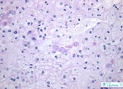 Leverbiopsie: de paarse verkleuring toont de aanwezigheid van afvalstoffen die zich opstapelen in de lever.