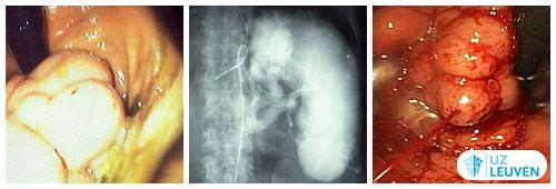 Maagkoepelvarices (links) - Grote splenorenale shunt die maagkoepelvarices veroorzaakt (midden) - Maagkoepelvaricesbloeding (rechts)