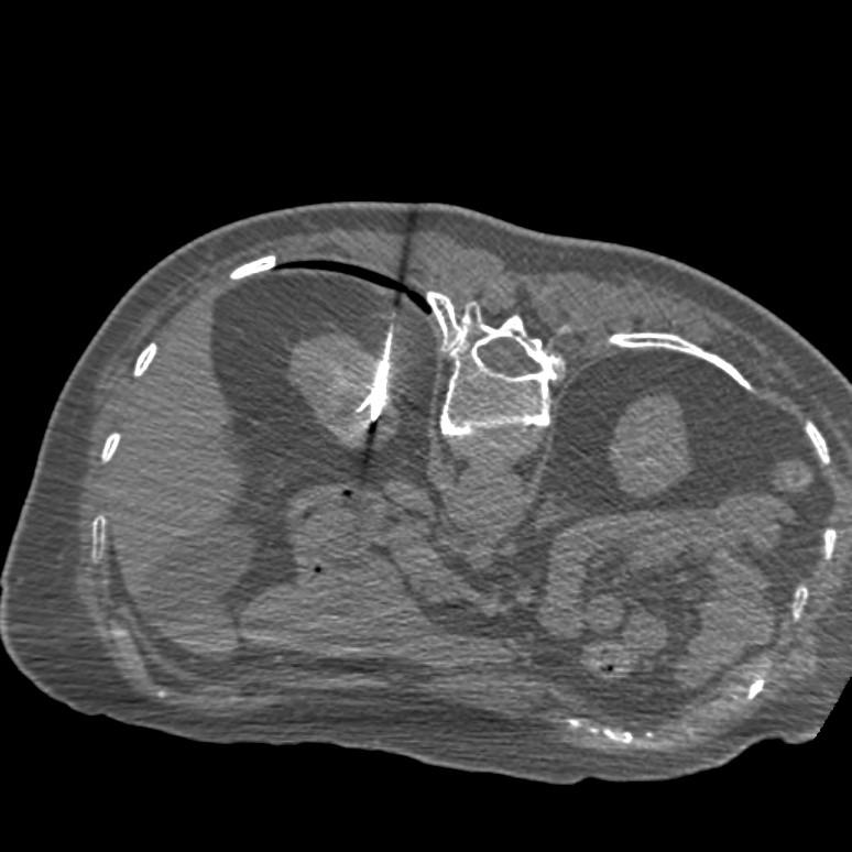 CT-scan van nier waarin RCC zich heeft ontwikkeld, behandeld met RFA.