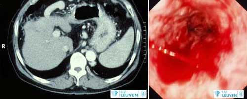 CT-scan die de open umbilicale venen aantoont (links) - Bloedende slokdarmvarices die worden opgewekt tijdens een endoscopie (rechts)