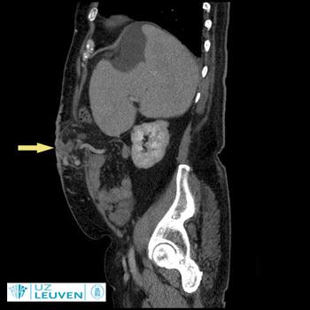 Stomavarices