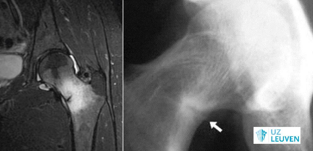 Stressfractuur van de femurhals met reactief botoedeem