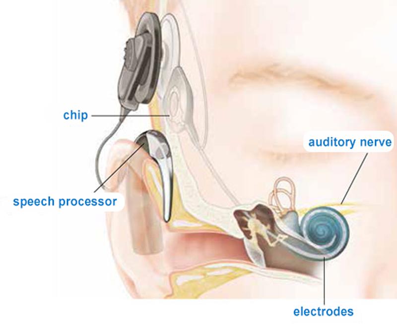 Cochlear implant