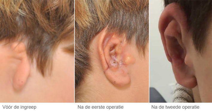 Resultaat oorschelpreconstructie