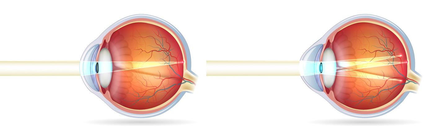 Normaal oog en oog met cylindrische afwijking (astigmatisme).
