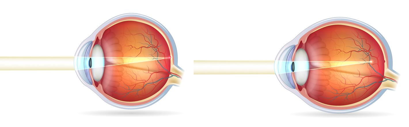 Omdat uw oog relatief te lang is, valt de focus voor het netvlies. Hierdoor ziet u verre voorwerpen wazig.