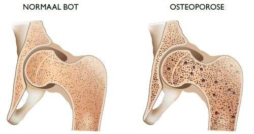 Normaal bot en bot met osteoporose