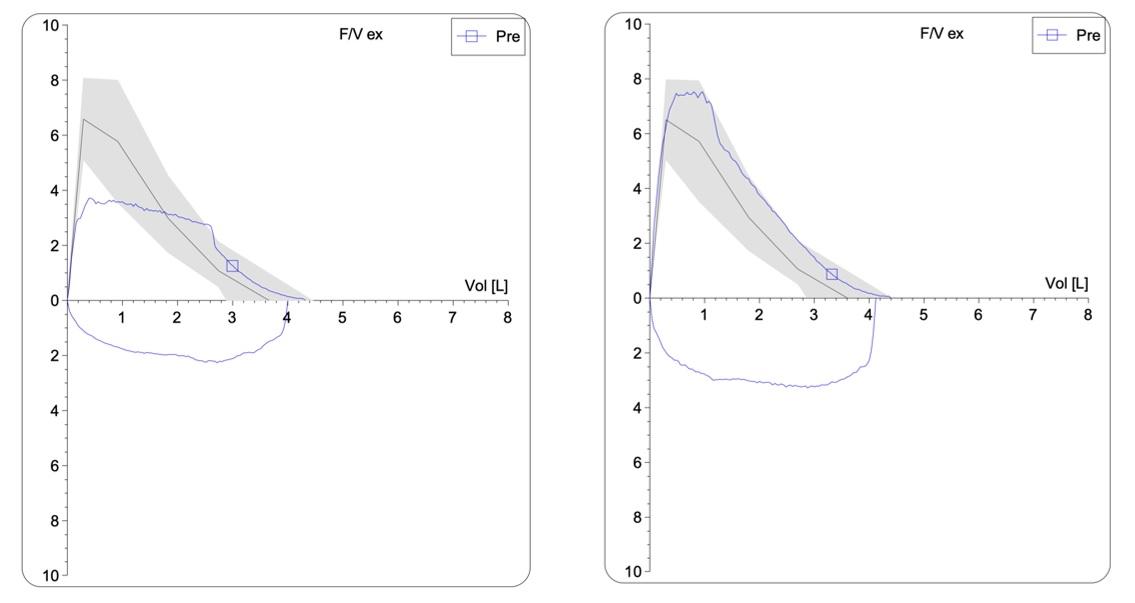 Flow-volume curve bij tracheastenose - Figuur 2.2.2