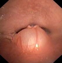 Endoscopisch beeld van een vallecula cyste, aan de tongbasis.