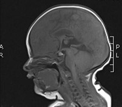 NMR beeld van Chiari malformatie