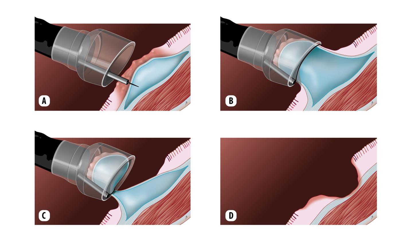 Endoscopische mucosale resectie (EMR)