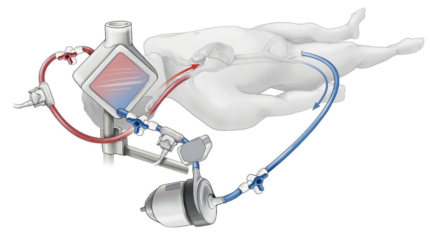 ECMO-circuit met geleiding van het bloed via canules, pomp en kunstlong
