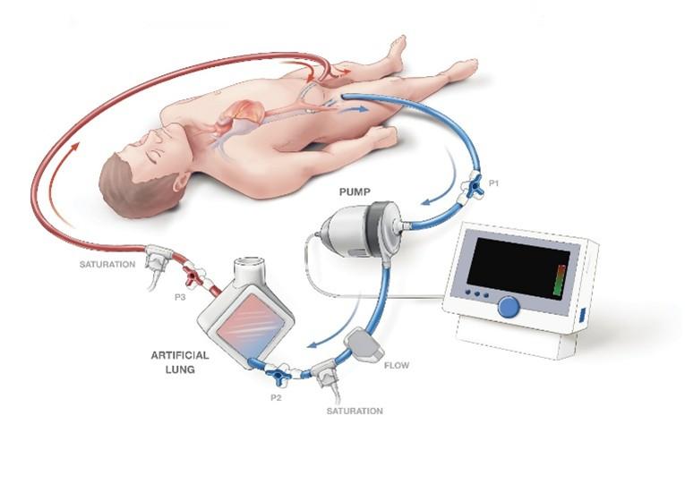 veno-arteriële ECMO-ondersteuning met teruggavecanule in de lies