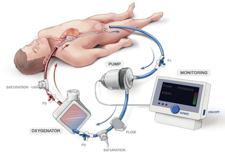 veno-veneuze ECMO-ondersteuning met teruggavecanule in de hals