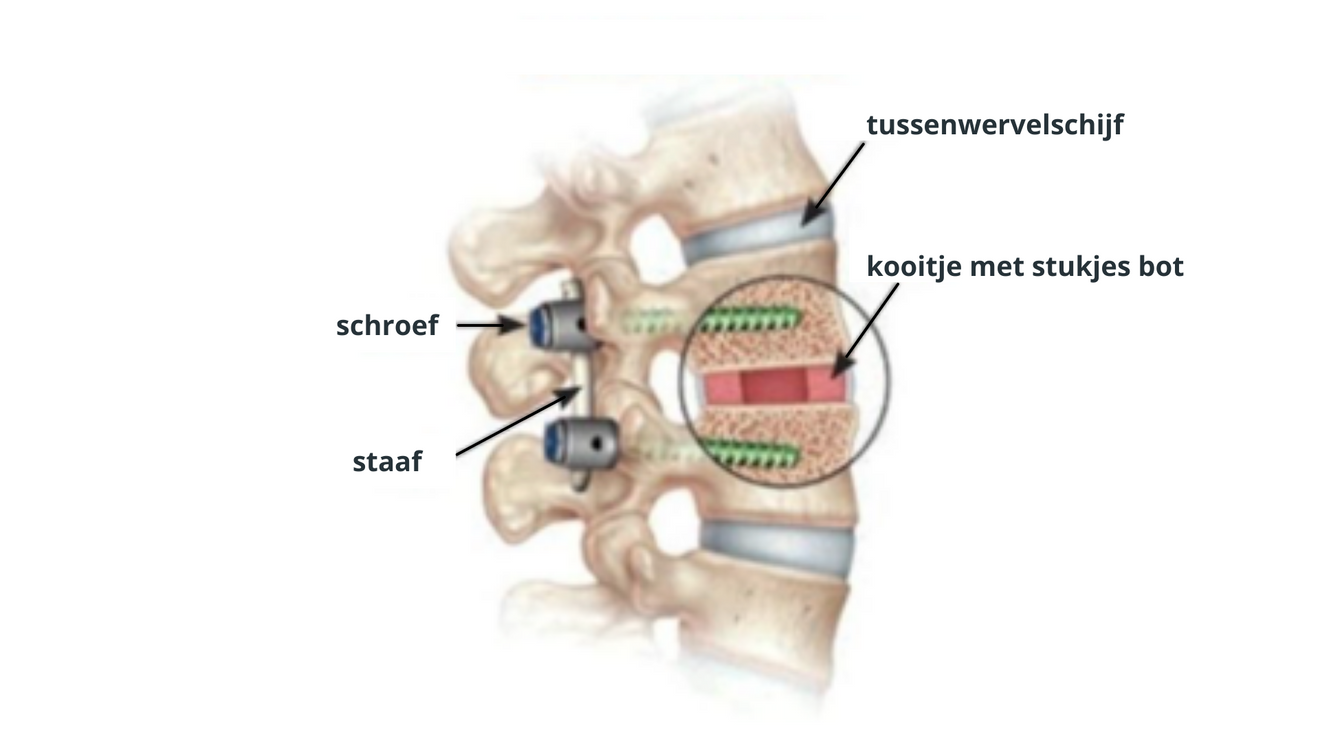 Lumbale fusie op 1 of 2 niveaus