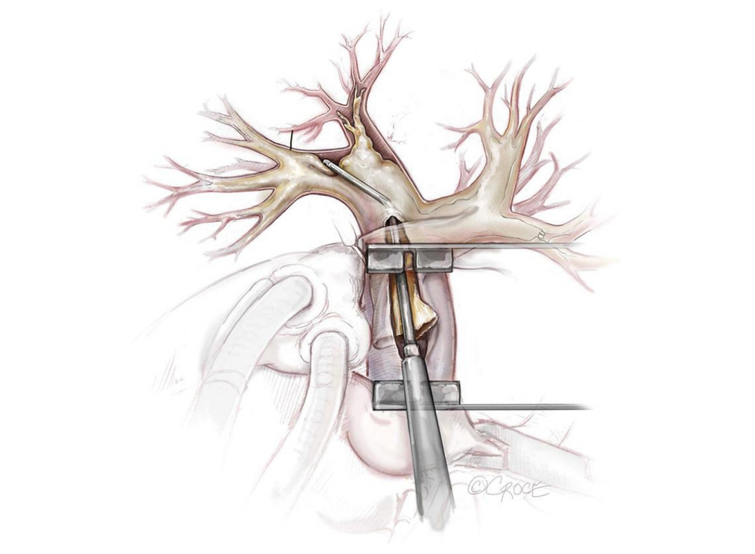 Pulmonale endarteriëctomie PEA