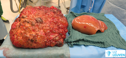 Verwijderde polycystische lever naast een normale lever die zal worden ingeplant tijdens een levertransplantatie.