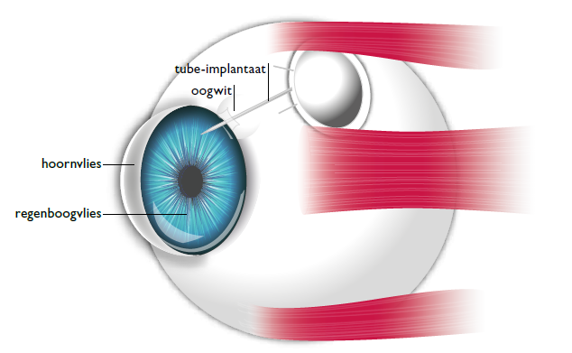 Tube-implantaat als behandeling voor glaucoom