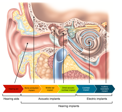 Hearing implants