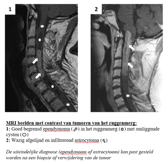 MR-scan met contrast van ruggenmergtumor