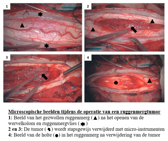 Operatie aan ruggenmergtumor