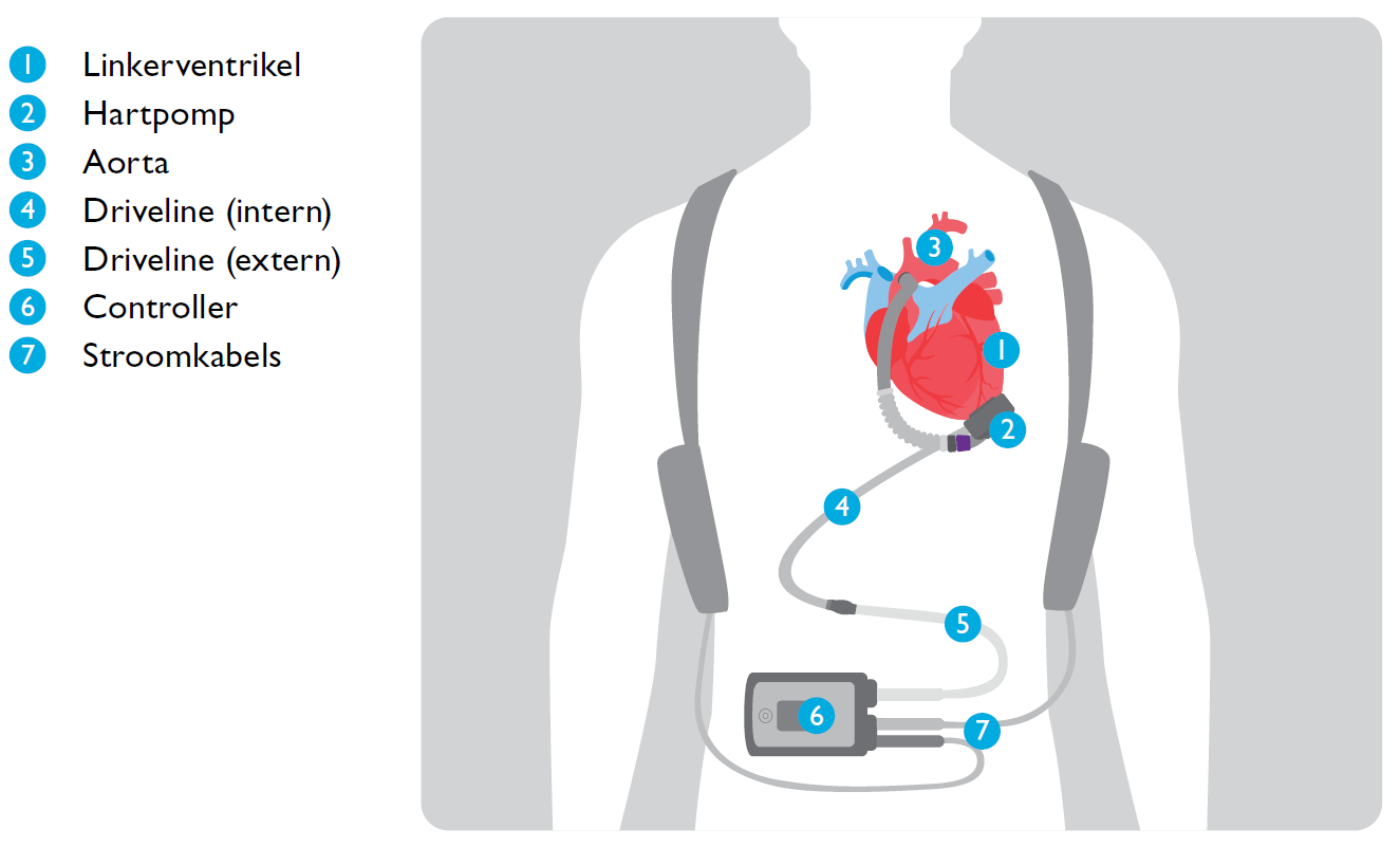 Werking left ventricular assist device (LVAD)