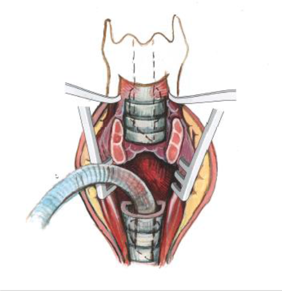 Figuur 4.2.3. Cross-field ventilation