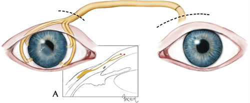 Corneale_neurotisatie.png