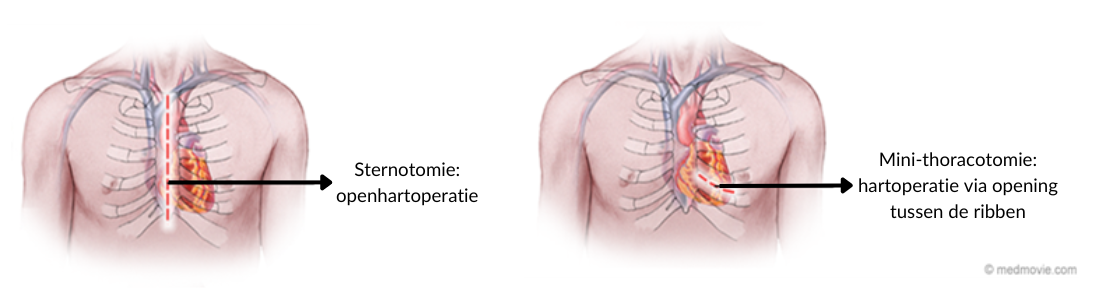 Coronary bypass surgery | UZ Leuven