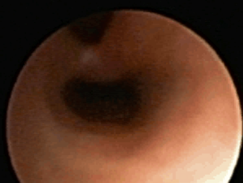 Laryngeale cleft type III