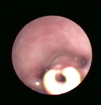 Endoscopisch beeld van type 2 laryngomalacie met lange opgekrulde epiglottis