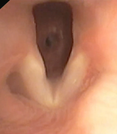 Endoscopisch beeld van subglottis stenose net onder niveau van de stembanden, ontstaan na langdurige intubatie. 