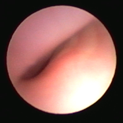 Endoscopisch beeld van volledige collaps anteroposterieur