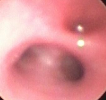 Endoscopisch beeld van tracheo-oesofagale fistel