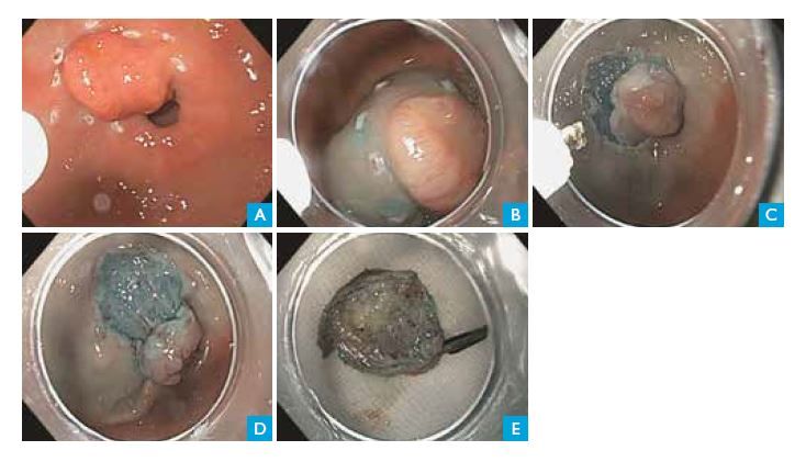 Endoscopische submucosale dissectie (ESD)