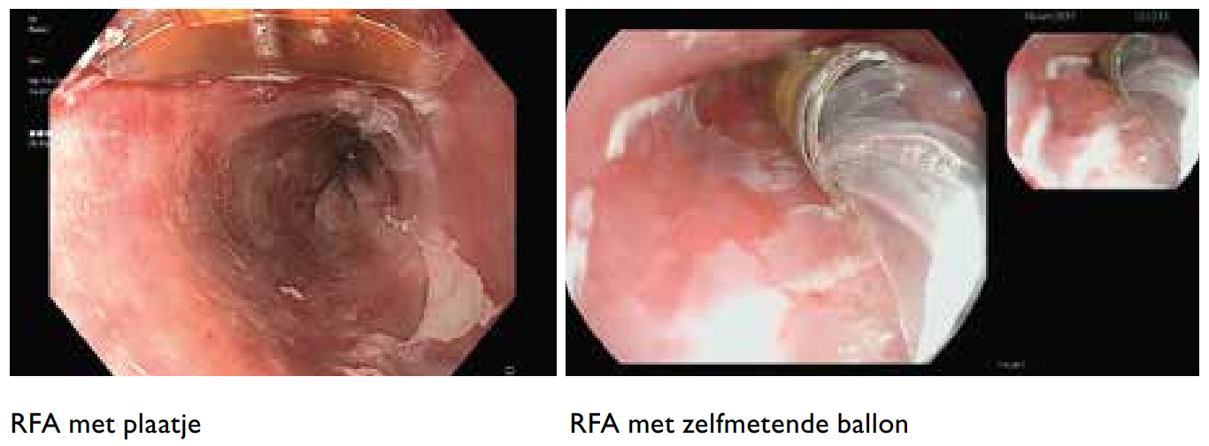 RFA met plaatje of zelfmetende ballon