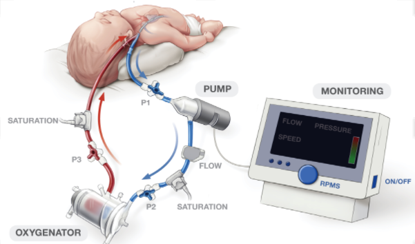 ECMO-systeem met geleiders, pomp en kunstlong