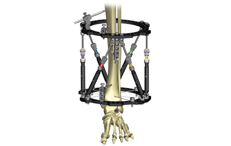 Taylor Spatial Frame (TSF) | UZ Leuven