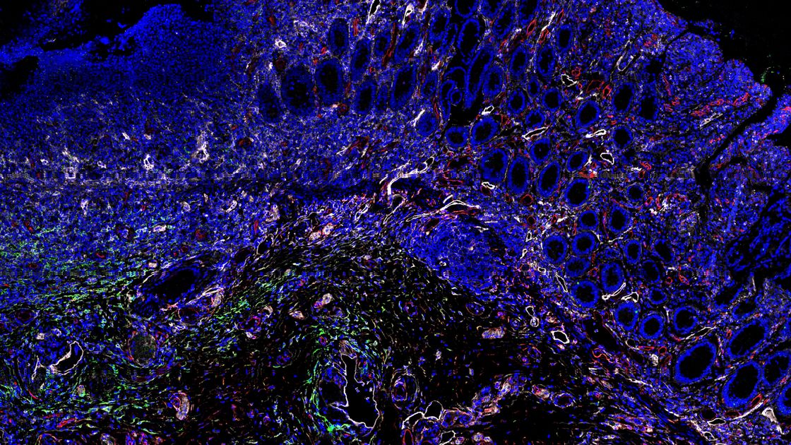 The Leuven examine unravels the underlying mechanism of intestinal fibrosis